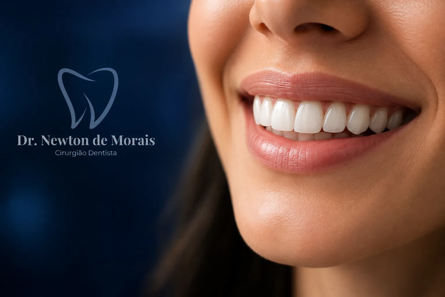 Sorriso com facetas de resina recém-aplicadas