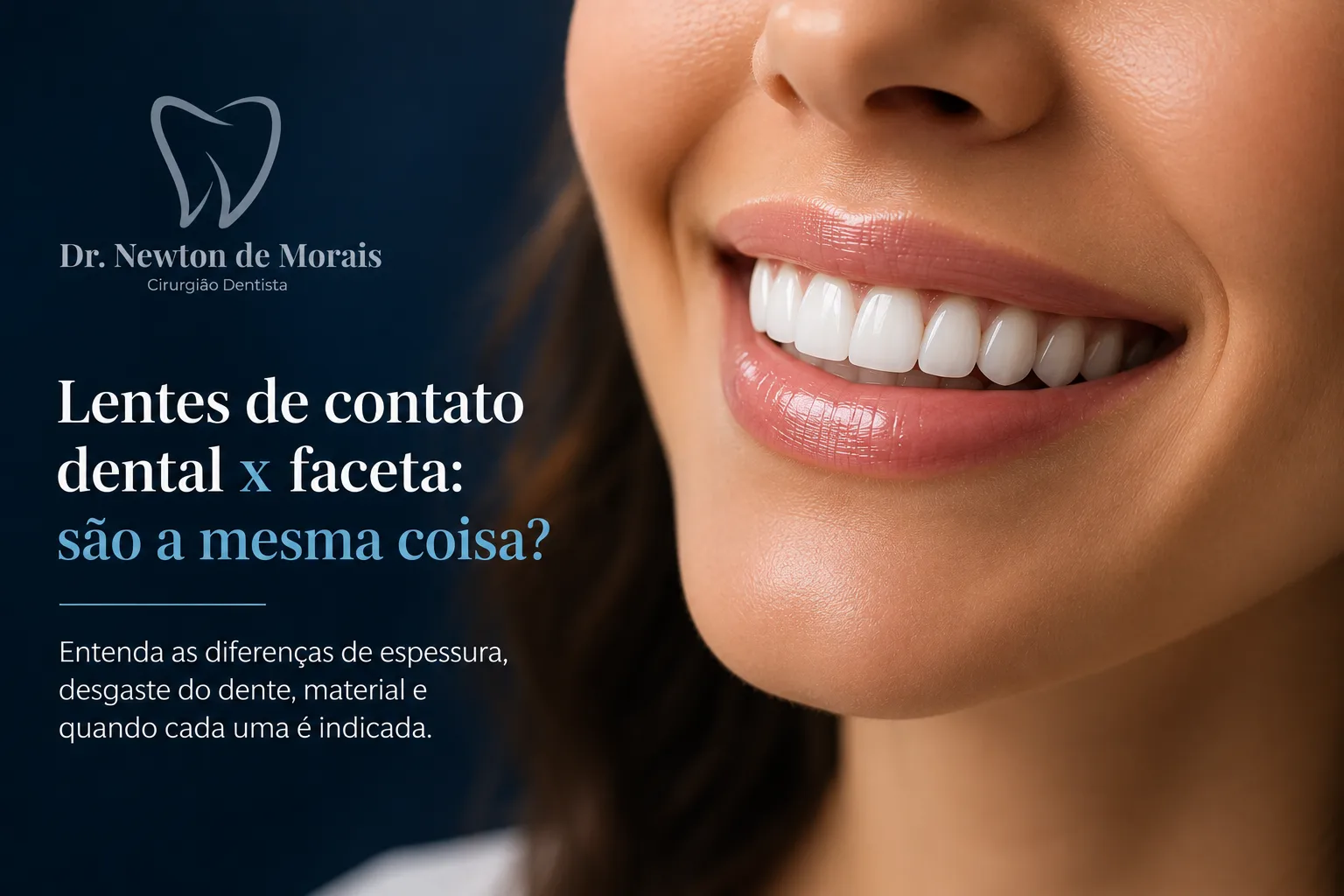 Sorriso com lentes de contato dental aplicadas